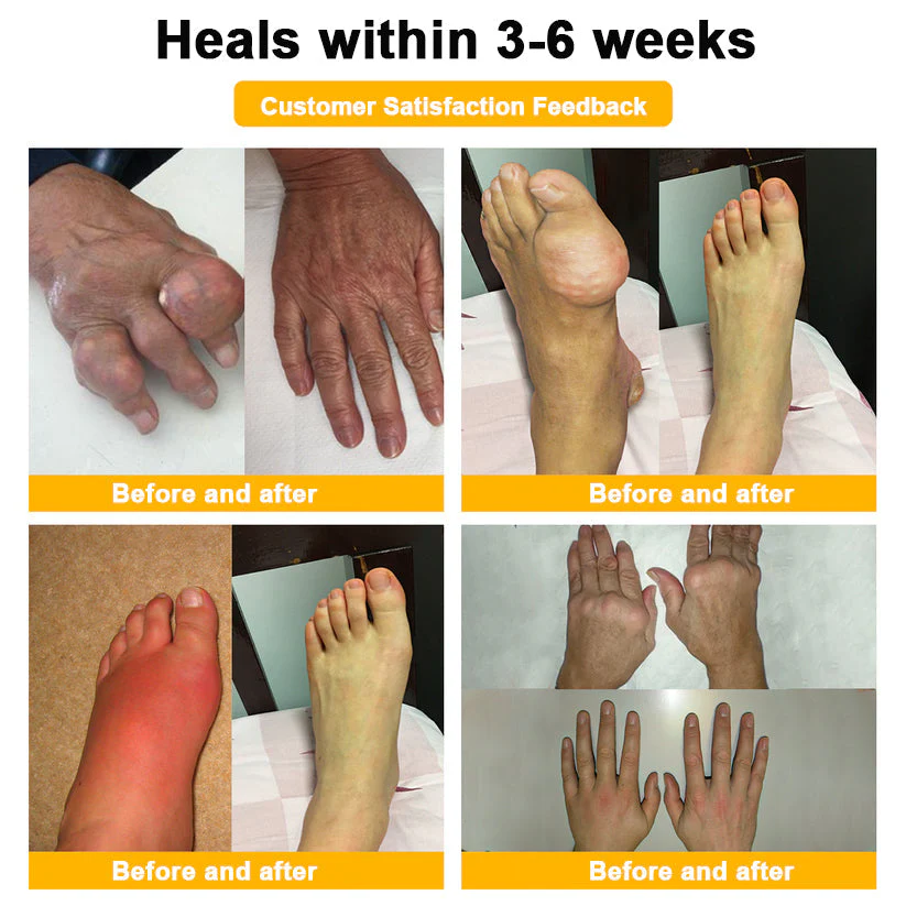 đFlash Sale - ODALIT⢠Botulinum Toxin & Bee Venom Pain-Relief Bone Healing Creamđđ - Image 15