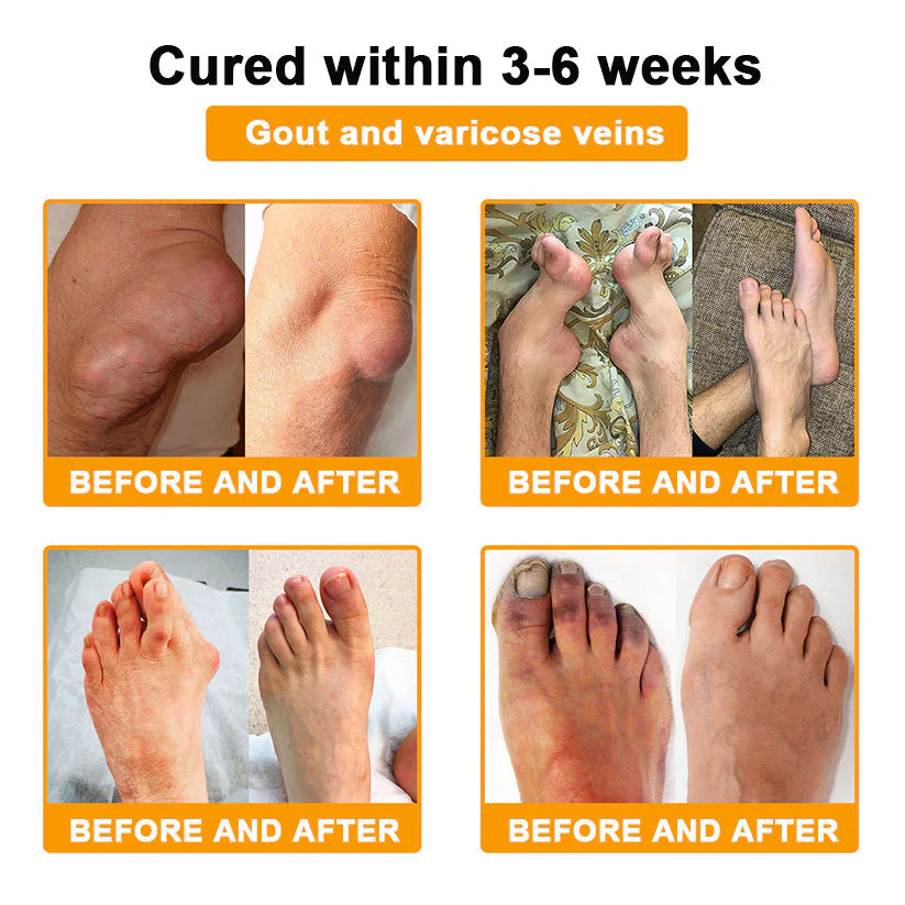 đFlash Sale - ODALIT⢠Botulinum Toxin & Bee Venom Pain-Relief Bone Healing Creamđđ - Image 17