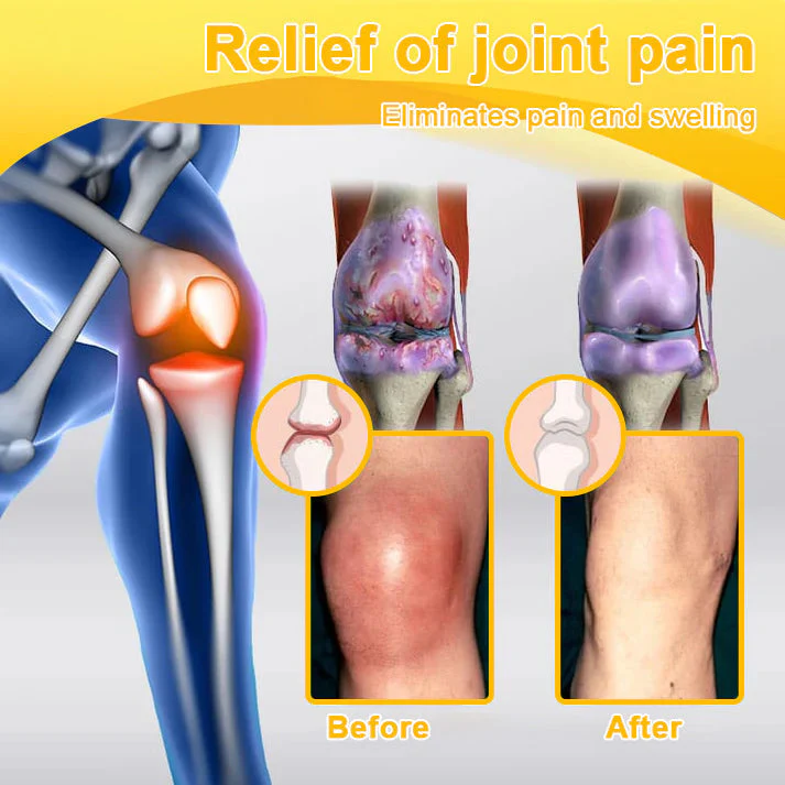 đFlash Sale - ODALIT⢠Botulinum Toxin & Bee Venom Pain-Relief Bone Healing Creamđđ - Image 3